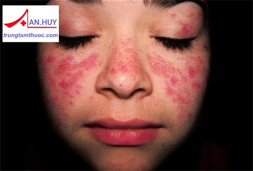Bệnh lupus ban đỏ hệ thống: những điều cần biết
