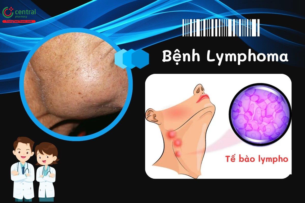 Bệnh ung thư hạch (Lymphoma): Phân loại, nguyên nhân, triệu chứng, chẩn đoán và điều trị