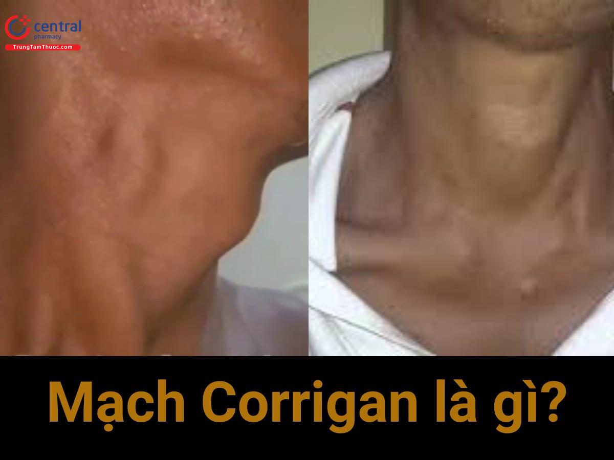 Mạch Corrigan là gì? Nguyên nhân khiến mạch nảy mạnh chìm sâu là gì?