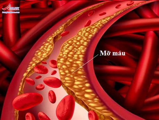 Sản phẩm giành cho người mỡ máu cao tốt nhất hiện nay