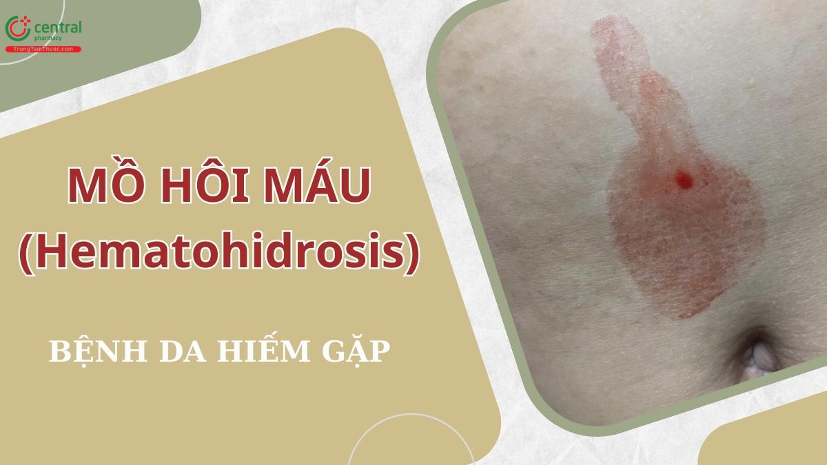Mồ hôi máu (Hematohidrosis): Nguyên nhân, xét nghiệm chẩn đoán và điều trị