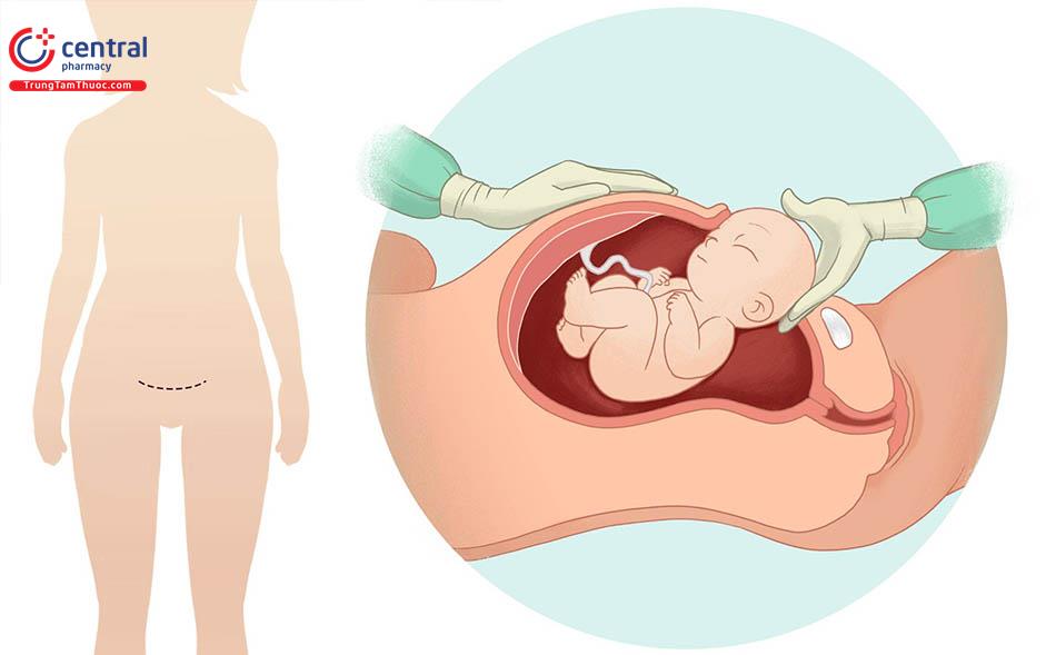 Các kỹ thuật mổ lấy thai hay dùng trong sản khoa 