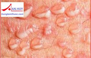 Mụn rộp sinh dục: chẩn đoán và điều trị như thế nào?