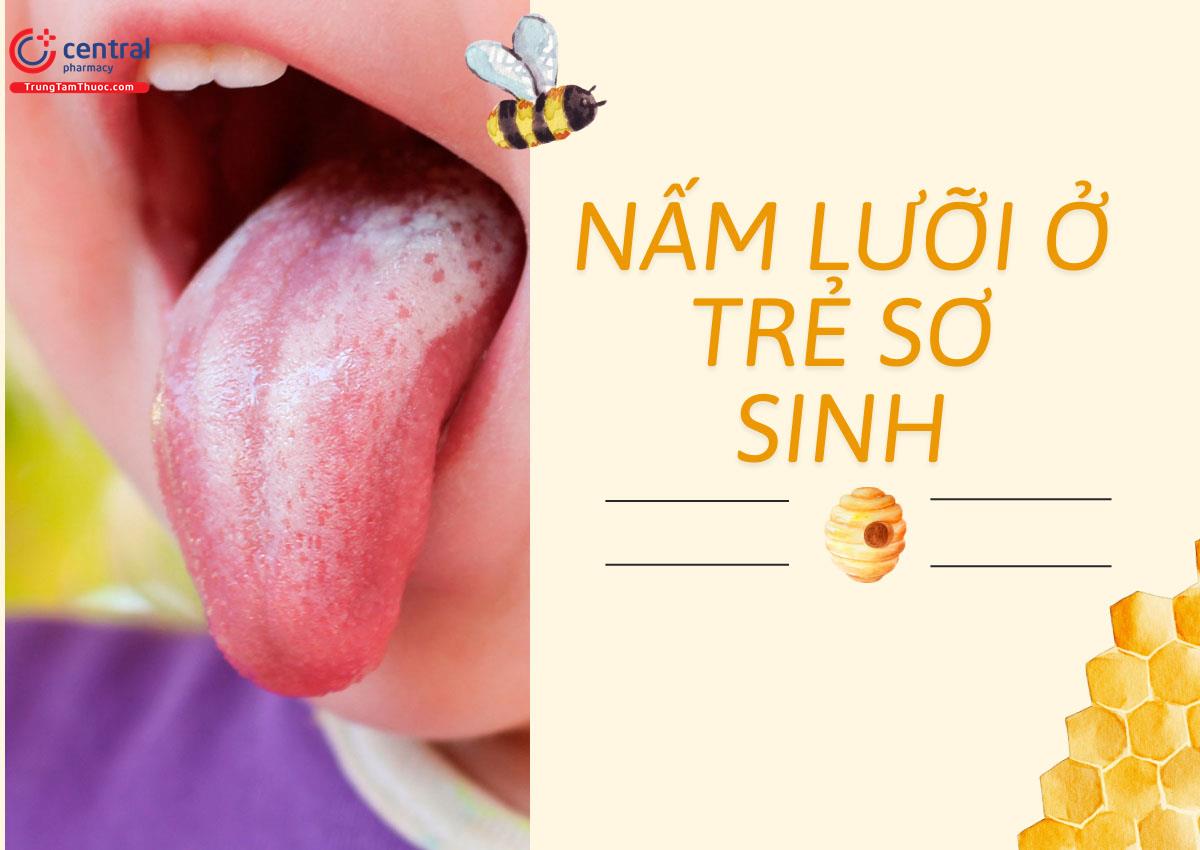 Nấm lưỡi ở trẻ sơ sinh - Nguyên nhân, dấu hiệu, phương pháp điều trị