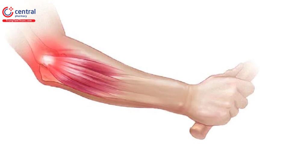 Nguyên nhân, chẩn đoán và điều trị viêm cầu lồi ngoài xương cánh tay