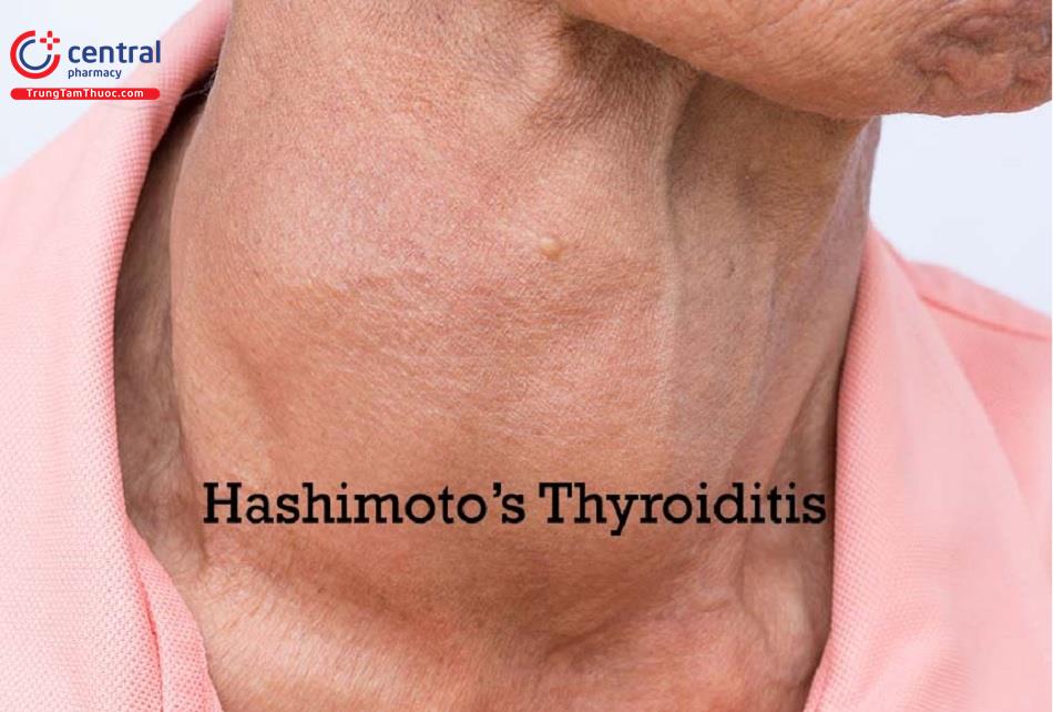 Nguyên nhân, triệu chứng, điều trị viêm tuyến giáp Hashimoto