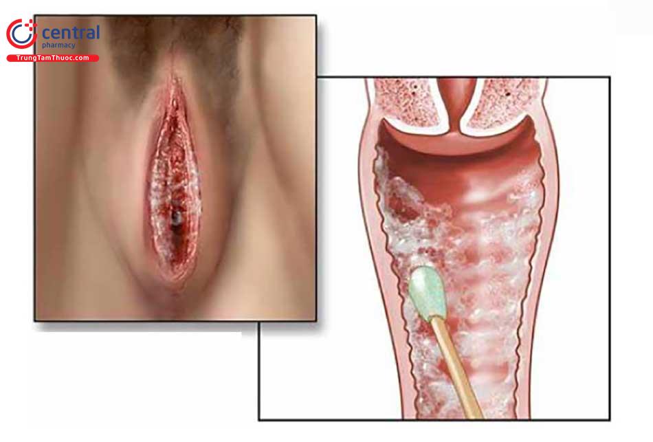 Nhiễm nấm âm đạo: quy trình chẩn đoán và cách điều trị