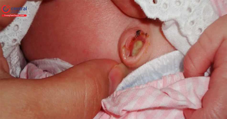 Nhiễm trùng rốn sơ sinh: Dấu hiệu, biến chứng, cách điều trị