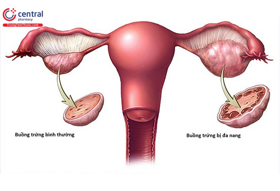 Những điều cần biết về hội chứng buồng trứng đa nang (PCOS)