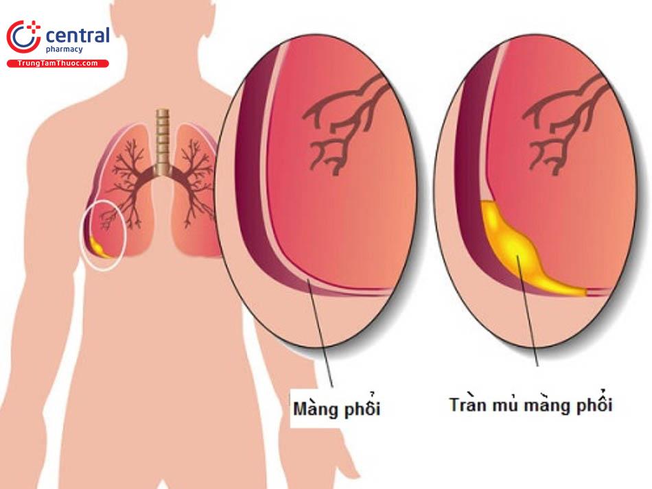 Những thông tin cần biết và bệnh tràn mủ màng phổi