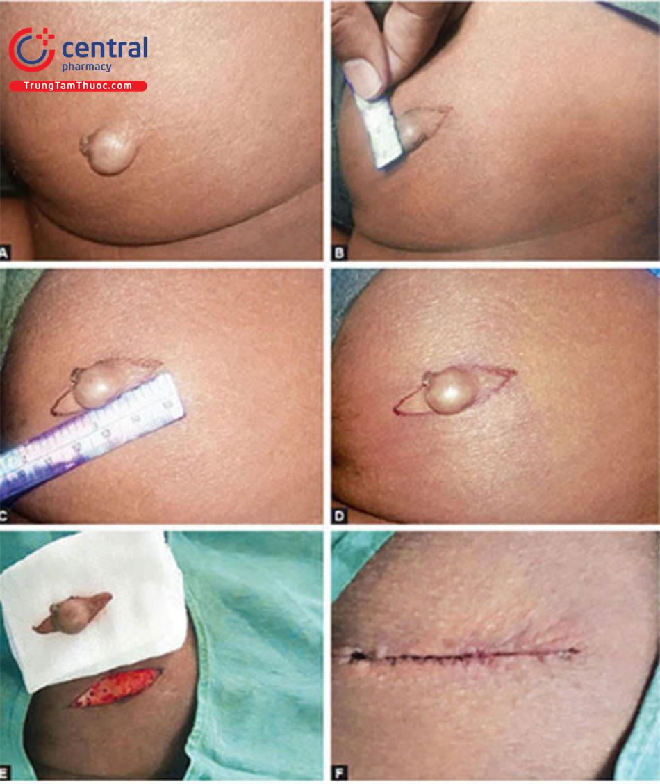 Phương pháp phẫu thuật cắt bỏ u nang và khối u nhỏ      