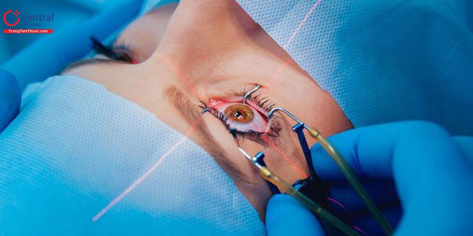 Đặc điểm giải phẫu mi mắt và những ứng dụng trong phẫu thuật mắt