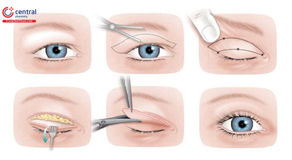 Phẫu thuật tạo hình mi mắt thẩm mỹ cho người châu Á