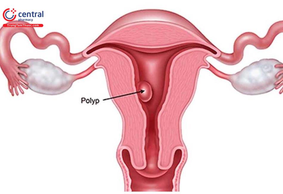 Polyp nội mạc tử cung: Cơ chế, chẩn đoán và cách điều trị