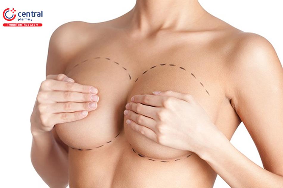 Quy trình nâng ngực và kế hoạch phẫu thuật dựa trên mô tuyến vú