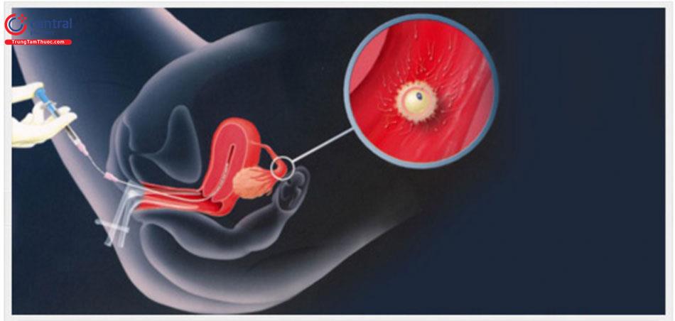 Bơm tinh trùng vào buồng tử cung - giải pháp cho cặp đôi hiếm muộn