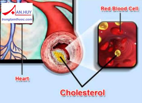NGUYÊN NHÂN, TRIỆU CHỨNG, ĐIỀU TRỊ RỐI LOẠN LIPID MÁU