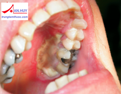 Răng sữa bị hoại tử tủy: chẩn đoán và điều trị bệnh