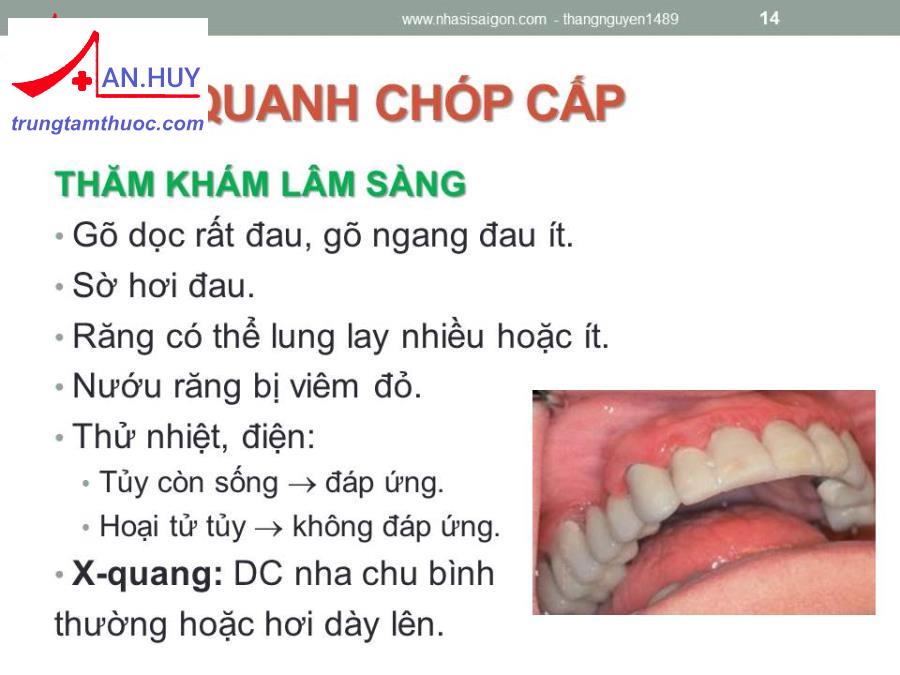 Bệnh viêm răng quanh chóp cấp: chẩn đoán và điều trị