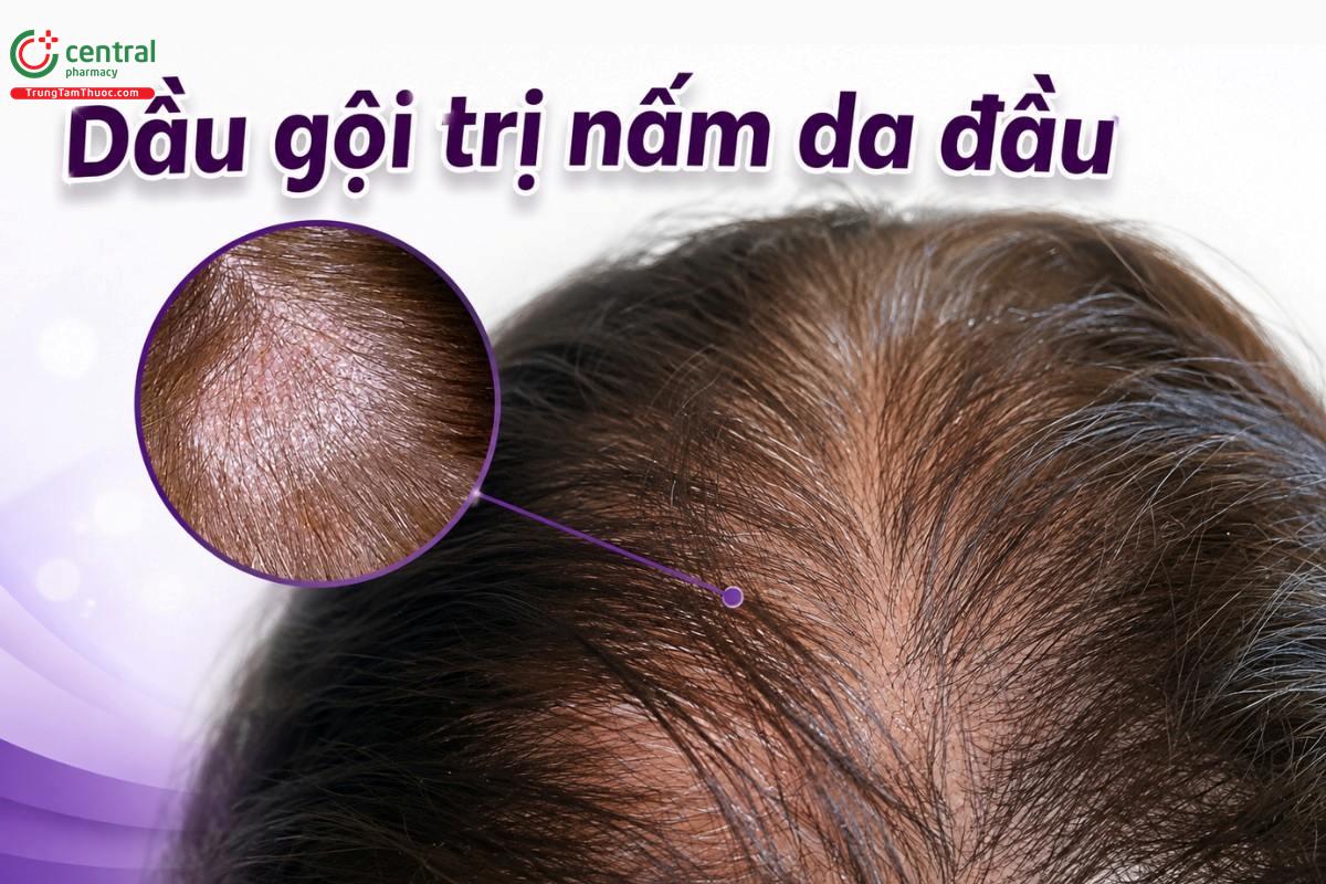REVIEW 5 loại dầu gội trị nấm hiệu quả được chuyên gia khuyên dùng