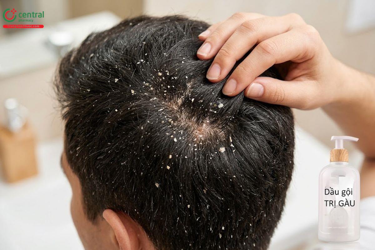[REVIEW] 8 loại dầu gội trị gàu hiệu quả được ưa chuộng