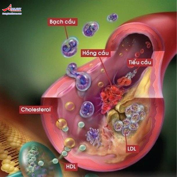 Bệnh rối loạn lipid máu: dấu hiệu, nguyên nhân và điều trị