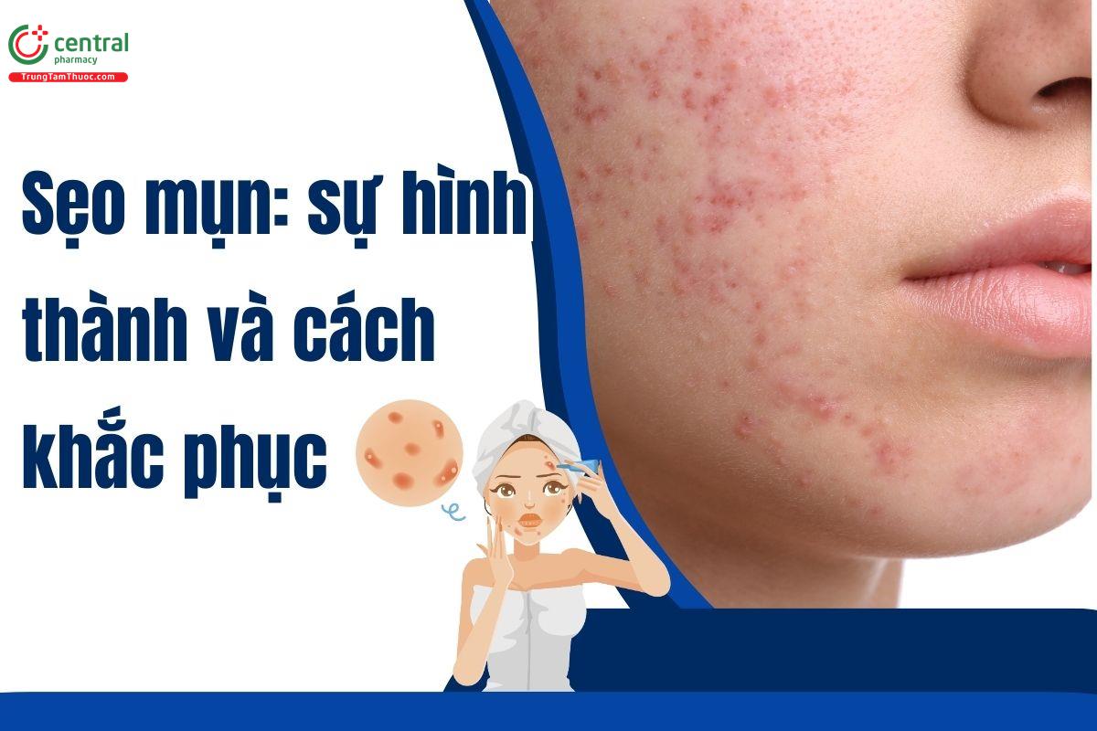 Sẹo mụn: sự hình thành, cách khắc phục và phương pháp điều trị 