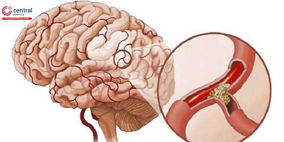Tai biến mạch máu não (Đột quỵ): Chẩn đoán và phác đồ xử trí