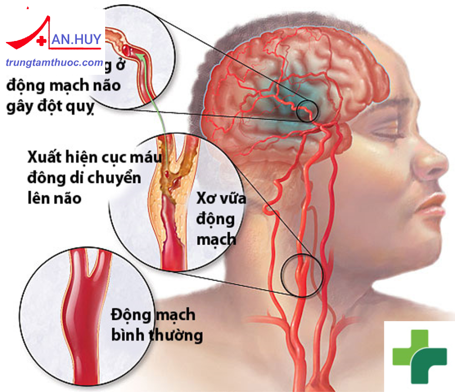 Những điều cần biết về tai biến mạch máu não (đột quỵ não)