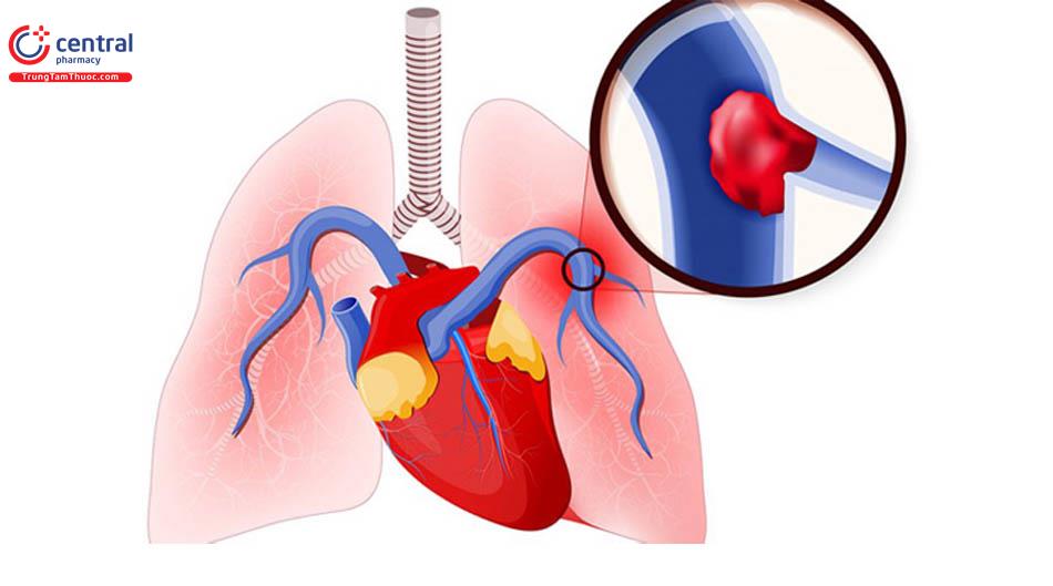 Tăng áp động mạch phổi: Nguyên nhân và cách điều trị