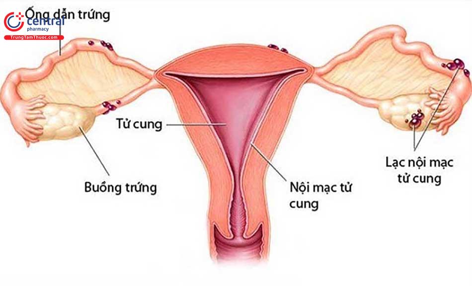 Tăng sinh nội mạc tử cung: nguyên nhân, triệu chứng và cách điều trị