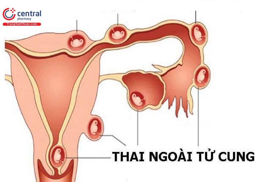 Thai lạc chỗ sau quá trình thụ tinh trong ống nghiệm