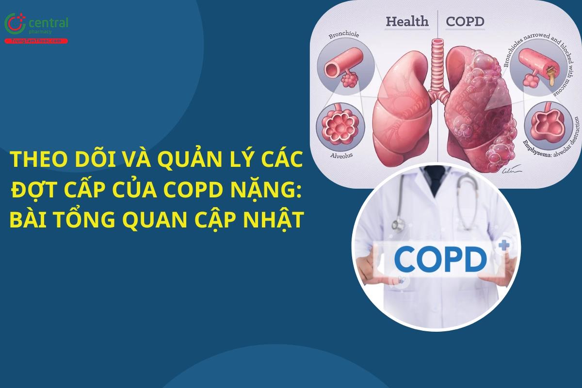 Theo dõi và quản lý các đợt cấp của COPD nặng: Bài tổng quan cập nhật