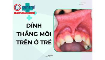 Trẻ bị dính thắng môi trên có sao không? Biểu hiện của dính thắng môi trên