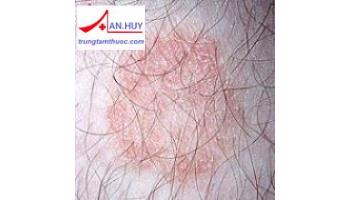 Bệnh nấm da do Dermatophytes: triệu chứng và điều trị