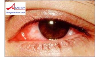 Bệnh viêm kết mạc do nhiễm virus: triệu chứng và điều trị