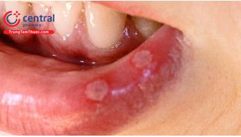 Bệnh Aphtose (nhiệt miệng): triệu chứng và cách điều trị