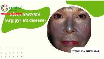 Bệnh Argyria (Argigyria's disease): Căn nguyên, biểu hiện, chẩn đoán, điều trị
