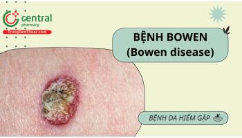 Bệnh Bowen (Bowen disease) - Một thể sớm của ung thư tế bào vảy