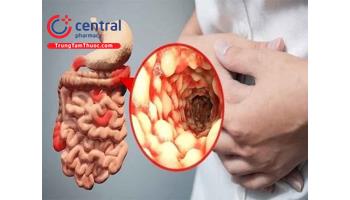 Bệnh Crohn: nguyên nhân, triệu chứng, chẩn đoán và điều trị