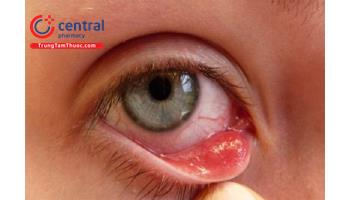 Bệnh đau mắt hột: triệu chứng và cách điều trị   