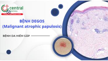Cách chẩn đoán và điều trị bệnh Degos (Malignant atrophic papulosis)