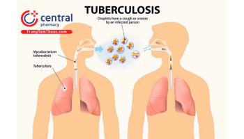 Bệnh lao ở người lớn: chẩn đoán, phác đồ điều trị và dự phòng