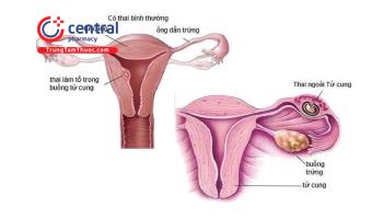 Bệnh lý vòi tử cung: Nguyên nhân, chẩn đoán và cách điều trị