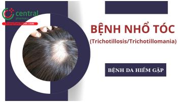 Bệnh nhổ tóc (Trichotillosis/Trichotillomania): nguyên nhân, biểu hiện, chẩn đoán và điều trị