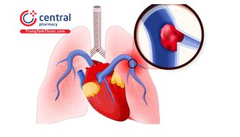 Bệnh tắc động mạch phổi cấp: chẩn đoán và hướng dẫn điều trị