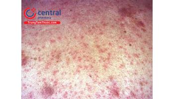 Bệnh thoái hóa bột và các tổn thương trên da (amyloidosis)