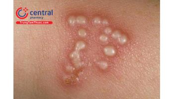 Bệnh viêm da dạng Herpes của Duhring-Brocq (Dermatitis Herpetiformis)