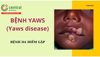 Bệnh Yaws (Yaws disease - Ghẻ cóc): Nguyên nhân, biểu hiện lâm sàng