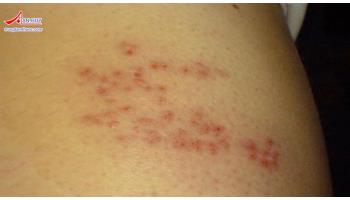 Bệnh giời leo: nguyên nhân, triệu chứng và điểu trị